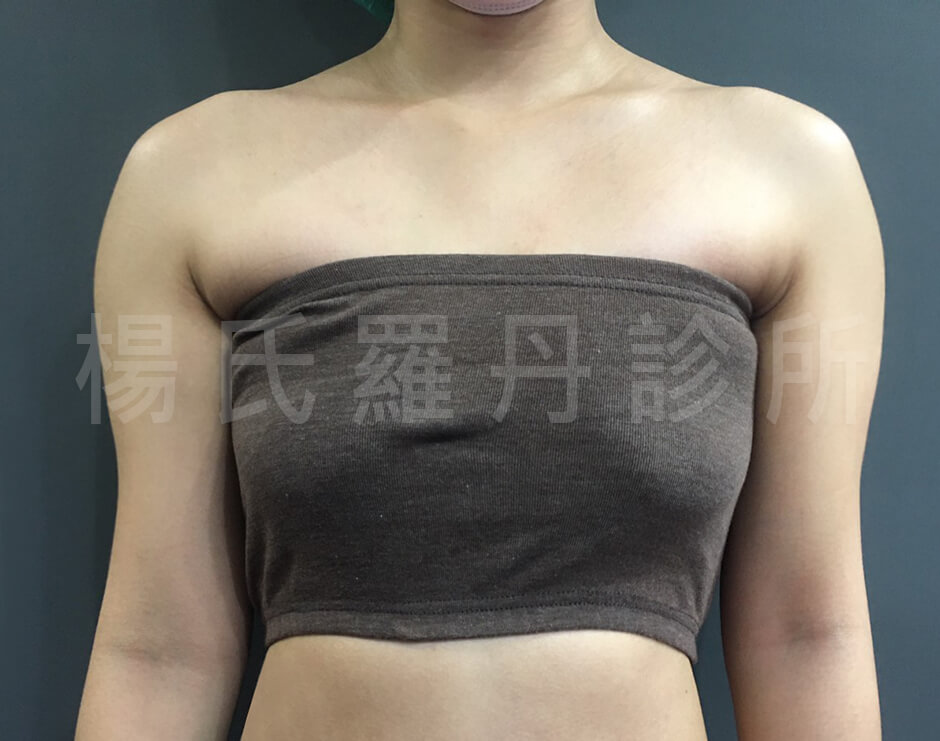 雕塑 贅肉 瘦手臂