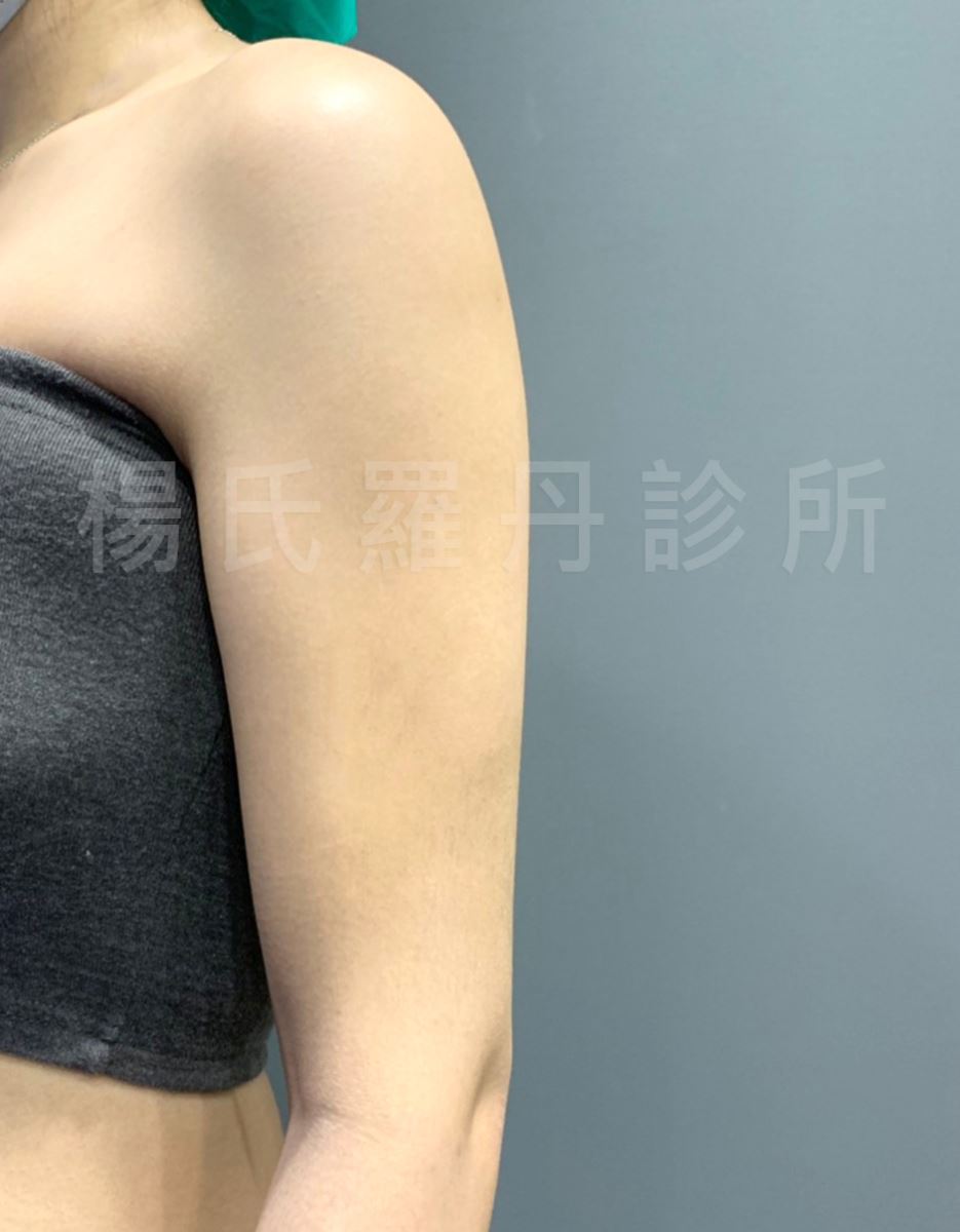 雷射減脂 贅肉