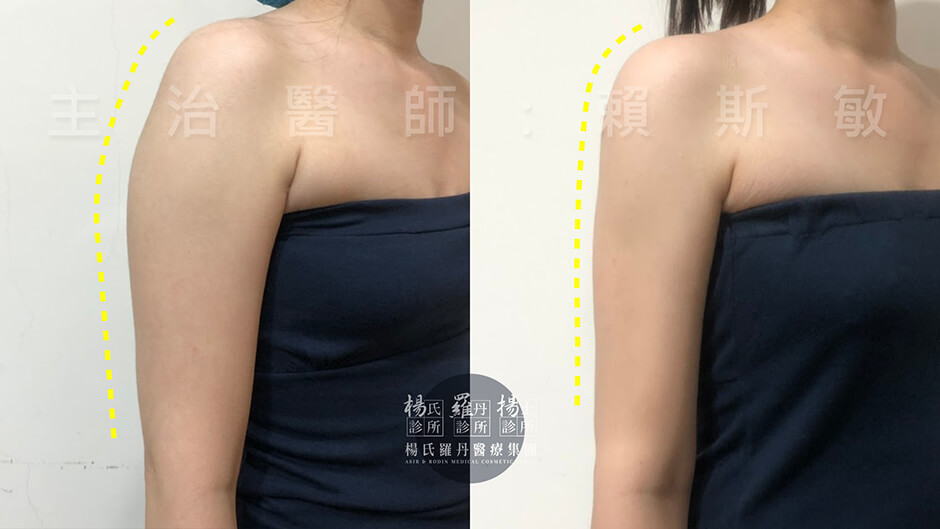 瘦手臂 雷射減脂手術