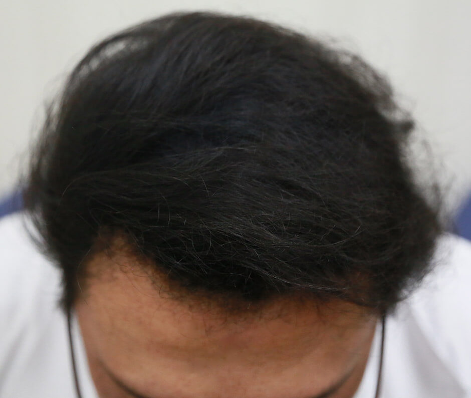 植髮成果 生髮613 ARTAS 雄性禿