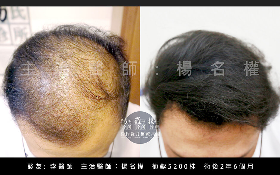 禿頭 植髮 掉髮 生髮613