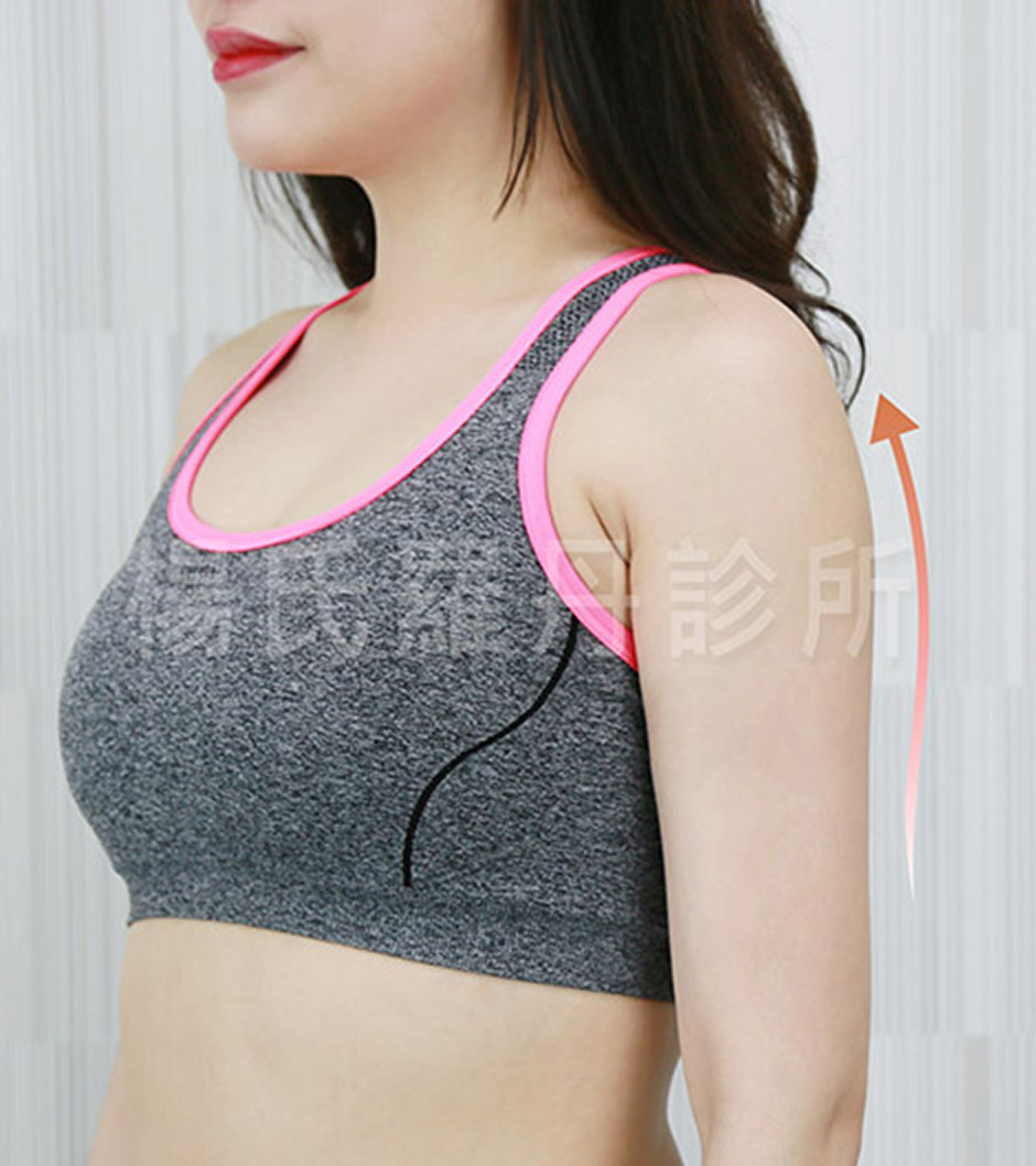 手臂 雷射減脂 瘦手臂