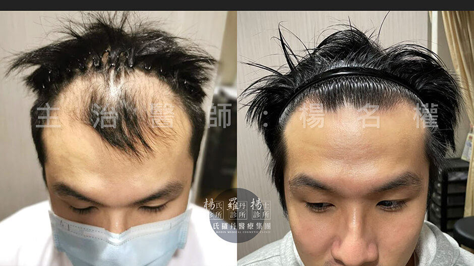 植髮 禿頭 生髮