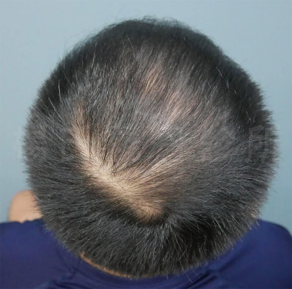 雄性禿  生髮效果  生髮 六合一三階段雄性禿治療