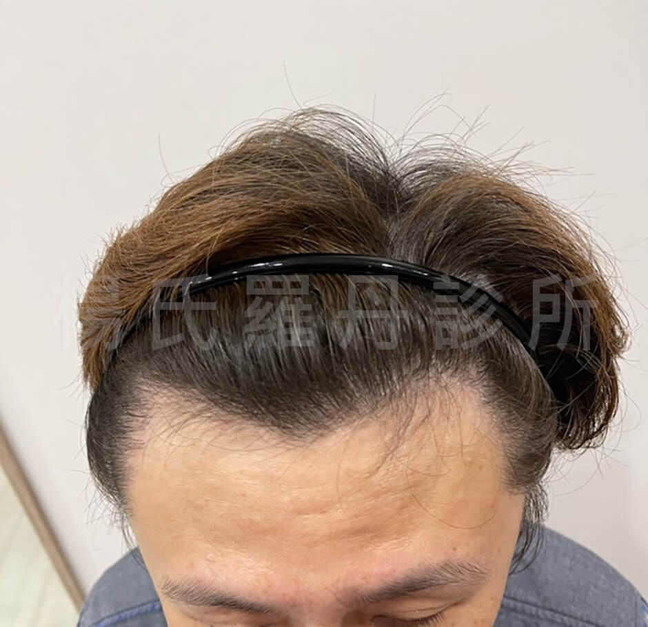 植髮 植髮心得 禿頭