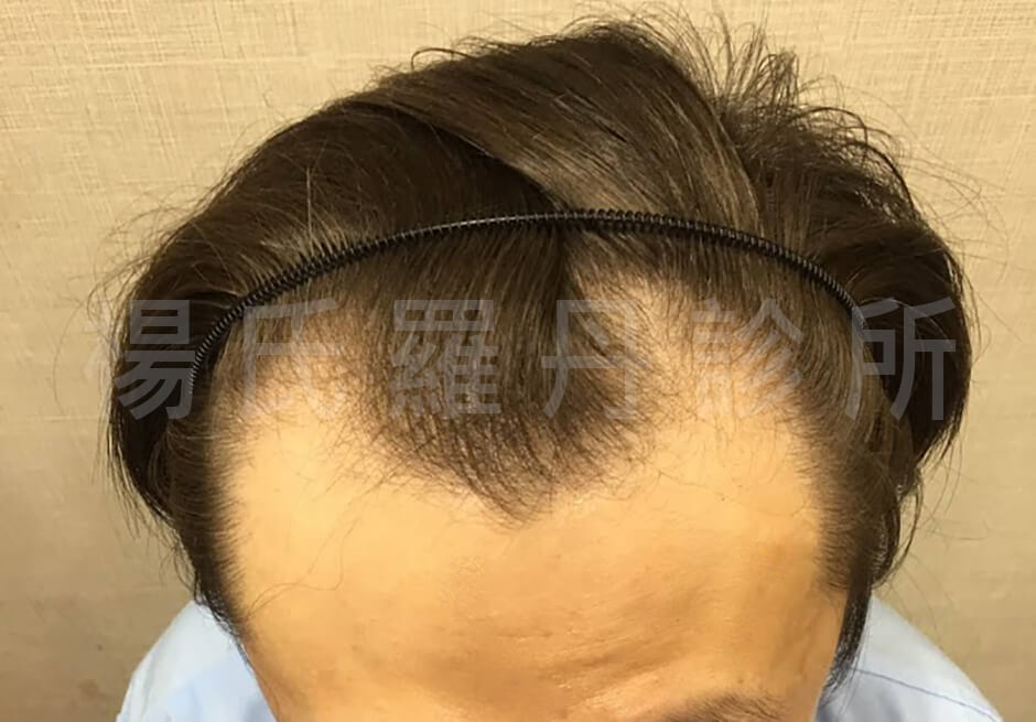 掉髮 禿頭  植髮