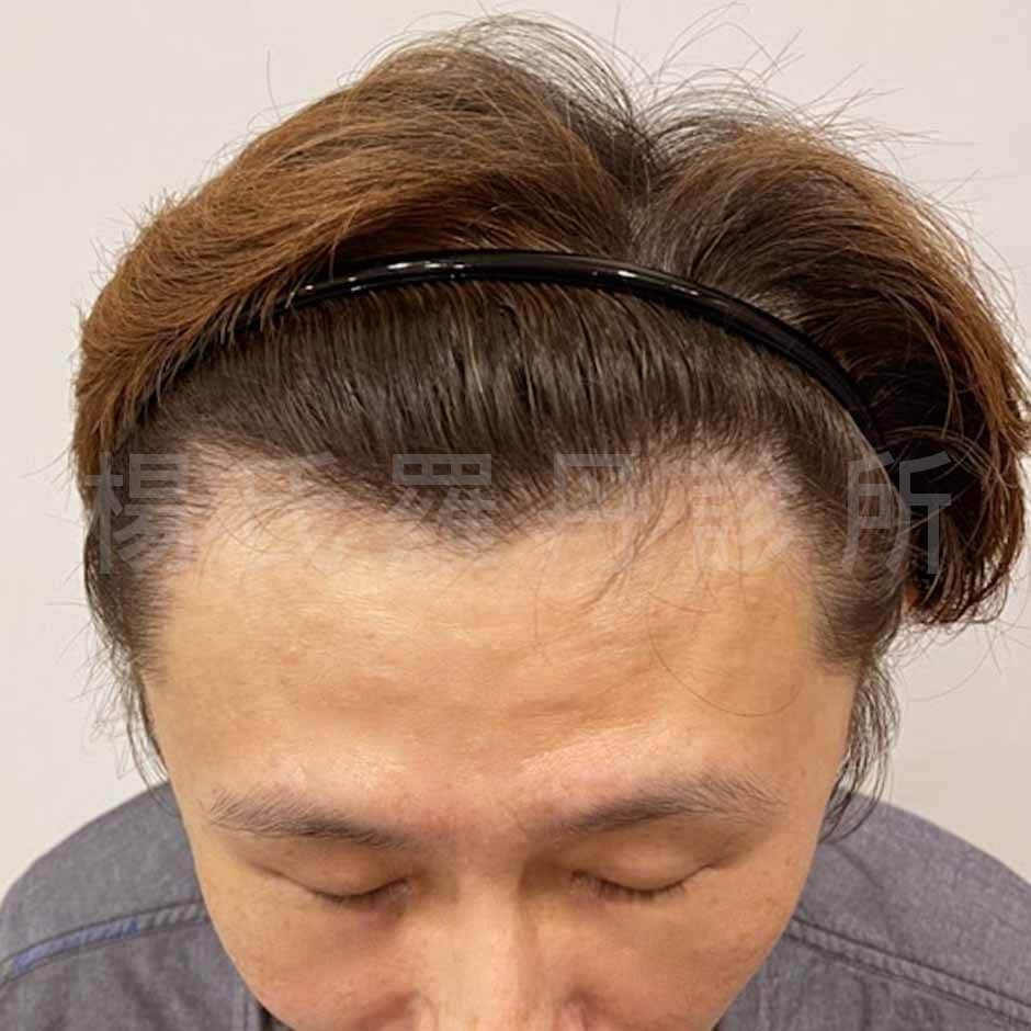 植髮心得 植髮 掉髮