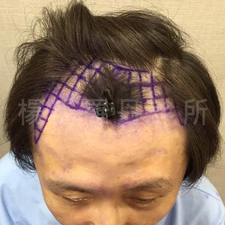 植髮 髮際線 禿頭