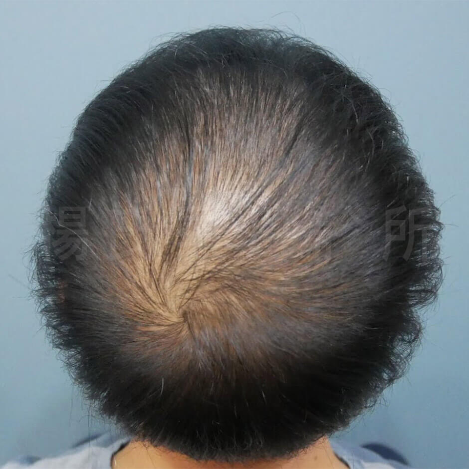 生髮 掉髮 雄性禿