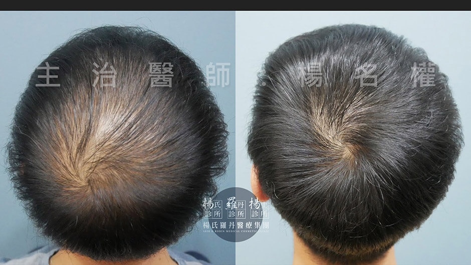 生髮 掉髮 雄性禿 生髮613