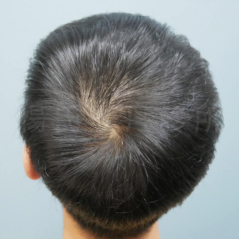 雄性禿 六合一三階段雄性禿治療 雄性禿治療 掉髮