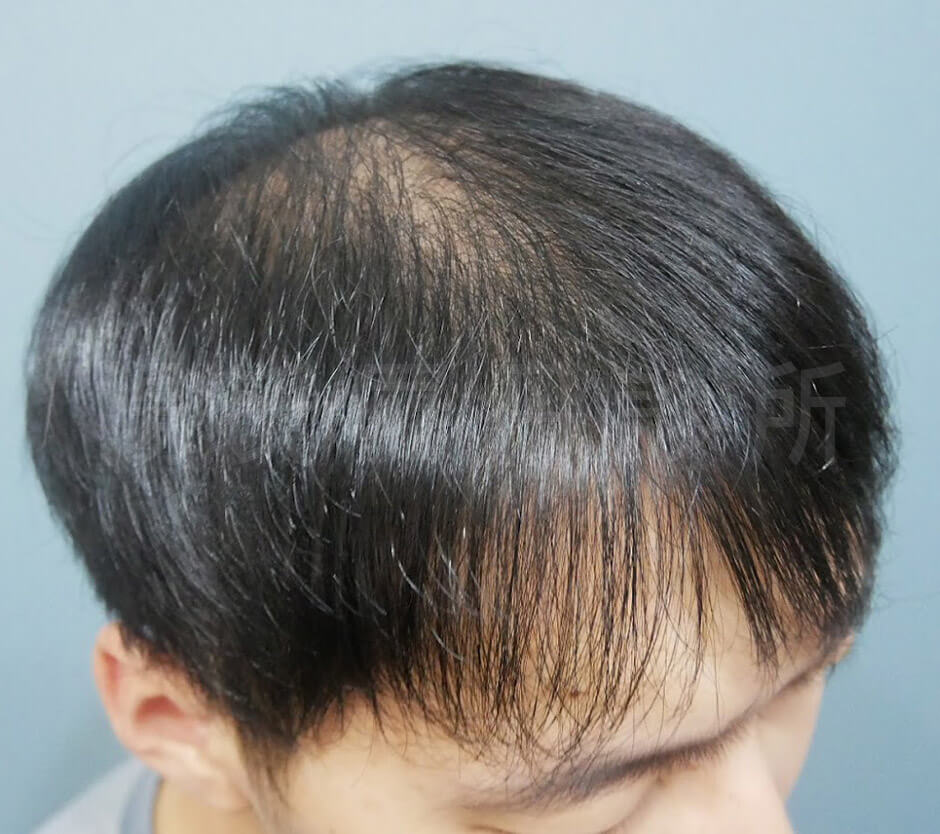 雄性禿 生髮 掉髮 生髮613