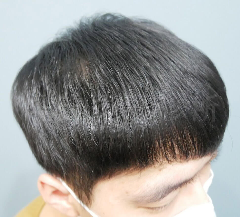 六合一三階段雄性禿治療 生髮 生髮613 掉髮嚴重