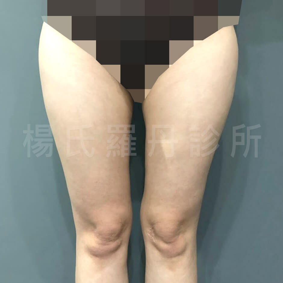 雕塑 馬鞍 雷射減脂