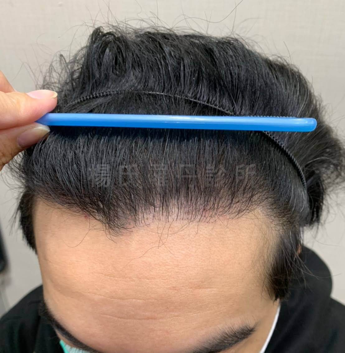 植髮 落髮  禿頭