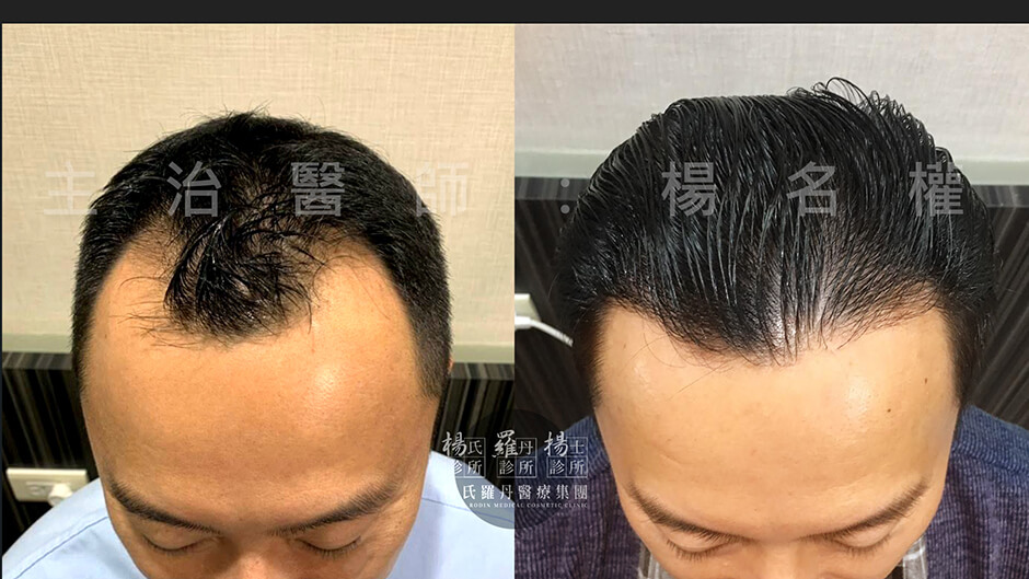 植髮 禿頭 落髮