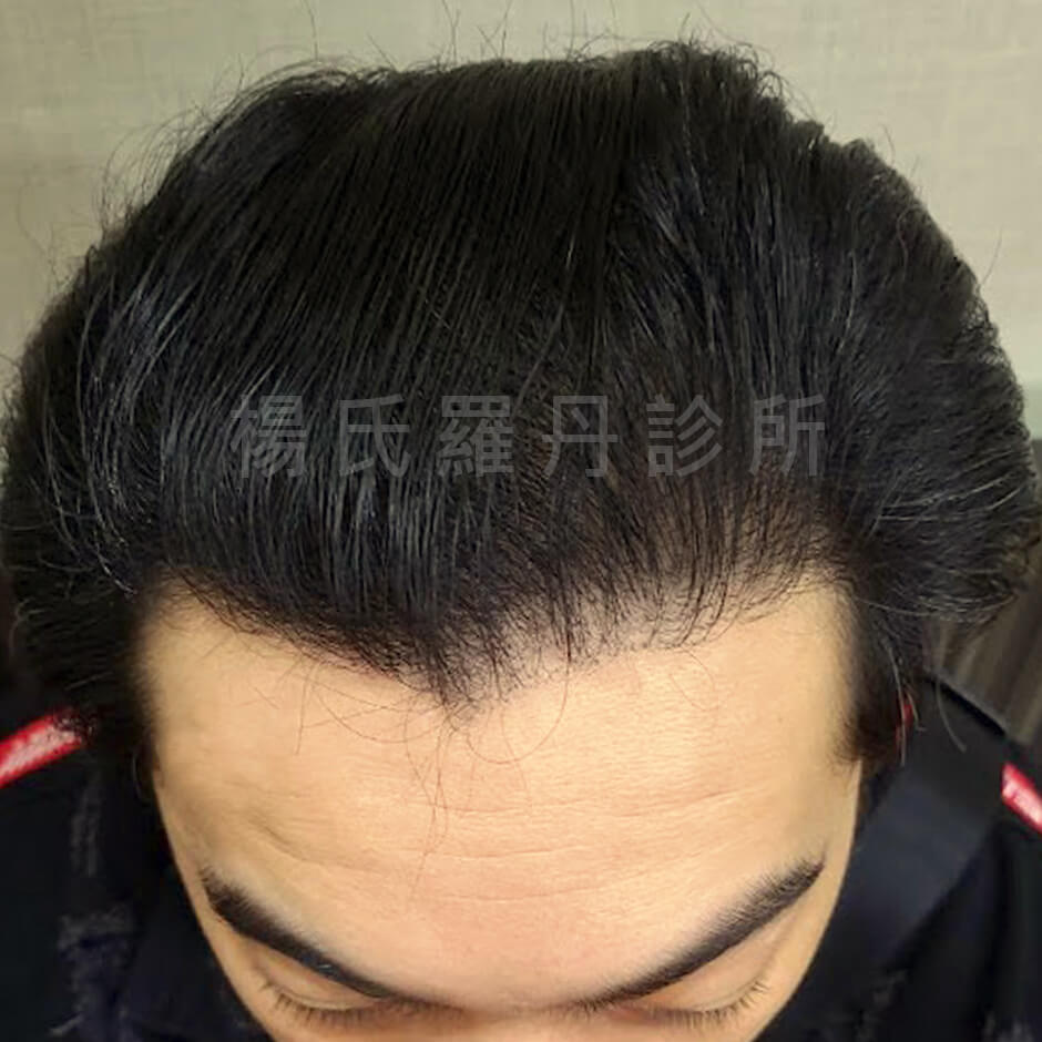 落髮嚴重 落髮 植髮