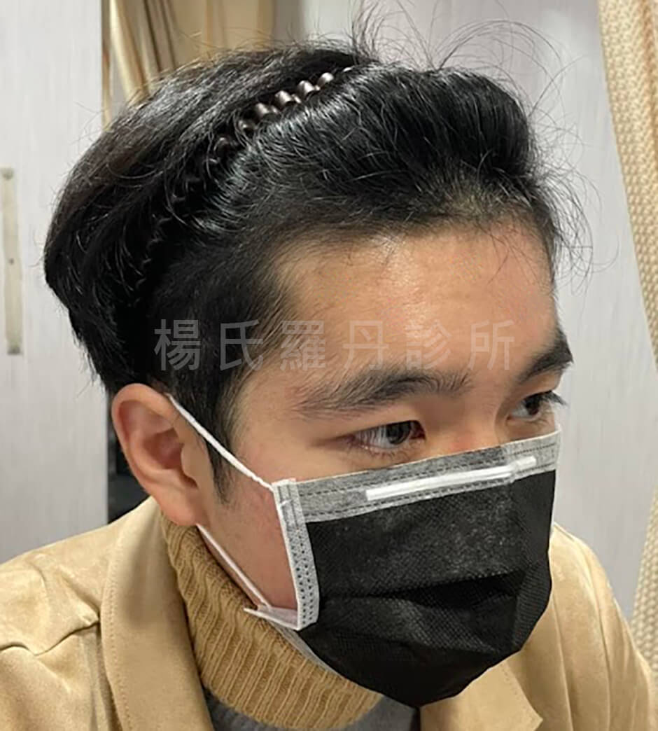 生髮  生髮成果 六合一三階段雄性禿治療  生髮療程