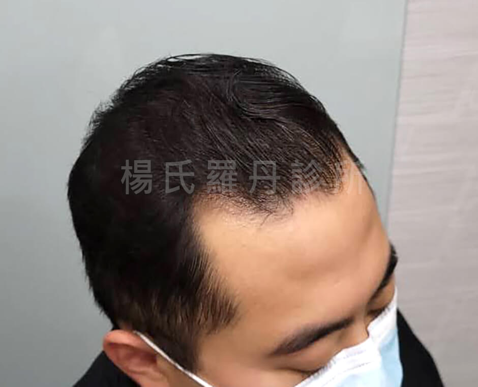 禿頭 落髮 落髮嚴重