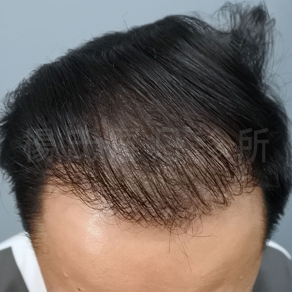 FUE植髮 落髮 禿頭