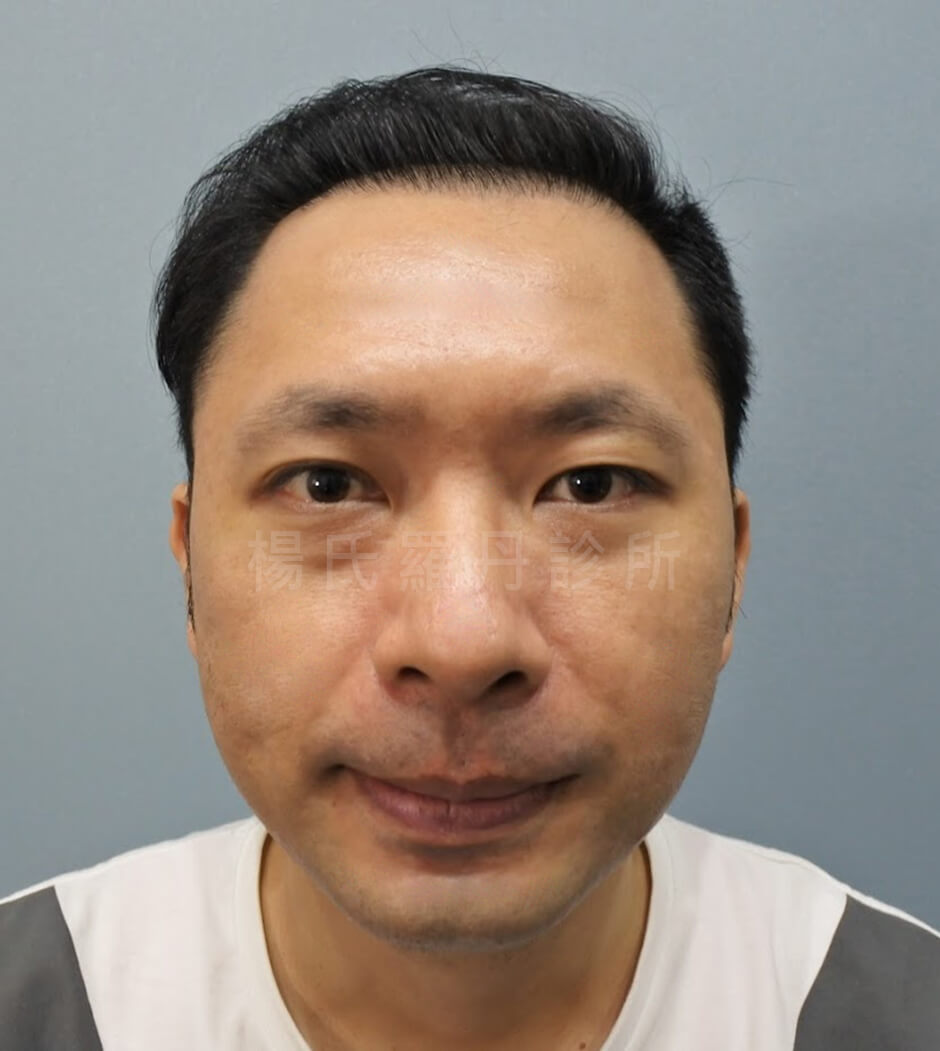 植髮 落髮 FUE植髮