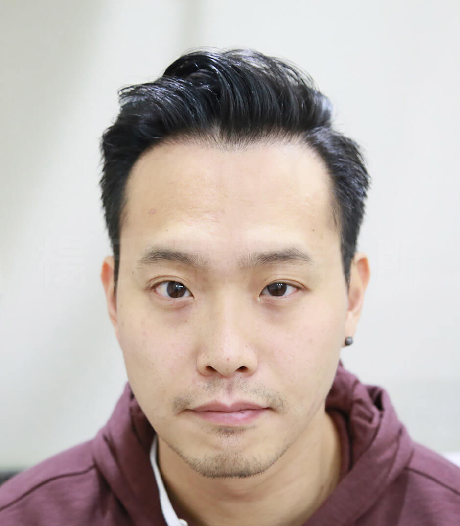 禿頭 禿頭前兆 髮際線 植髮 