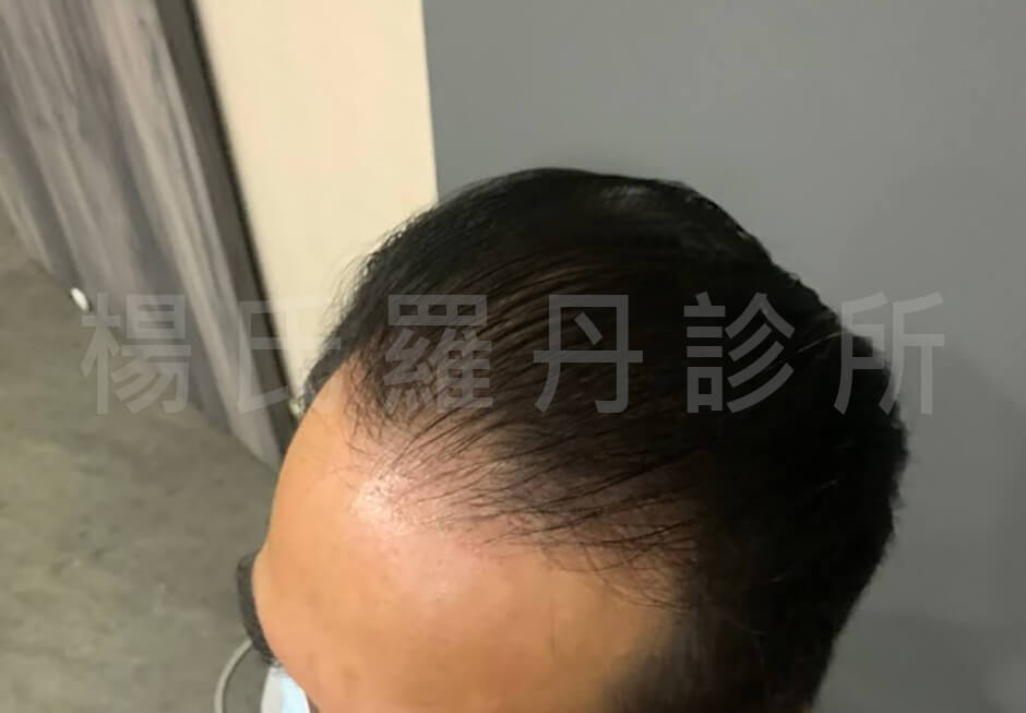 ARTAS 植髮案例 植髮