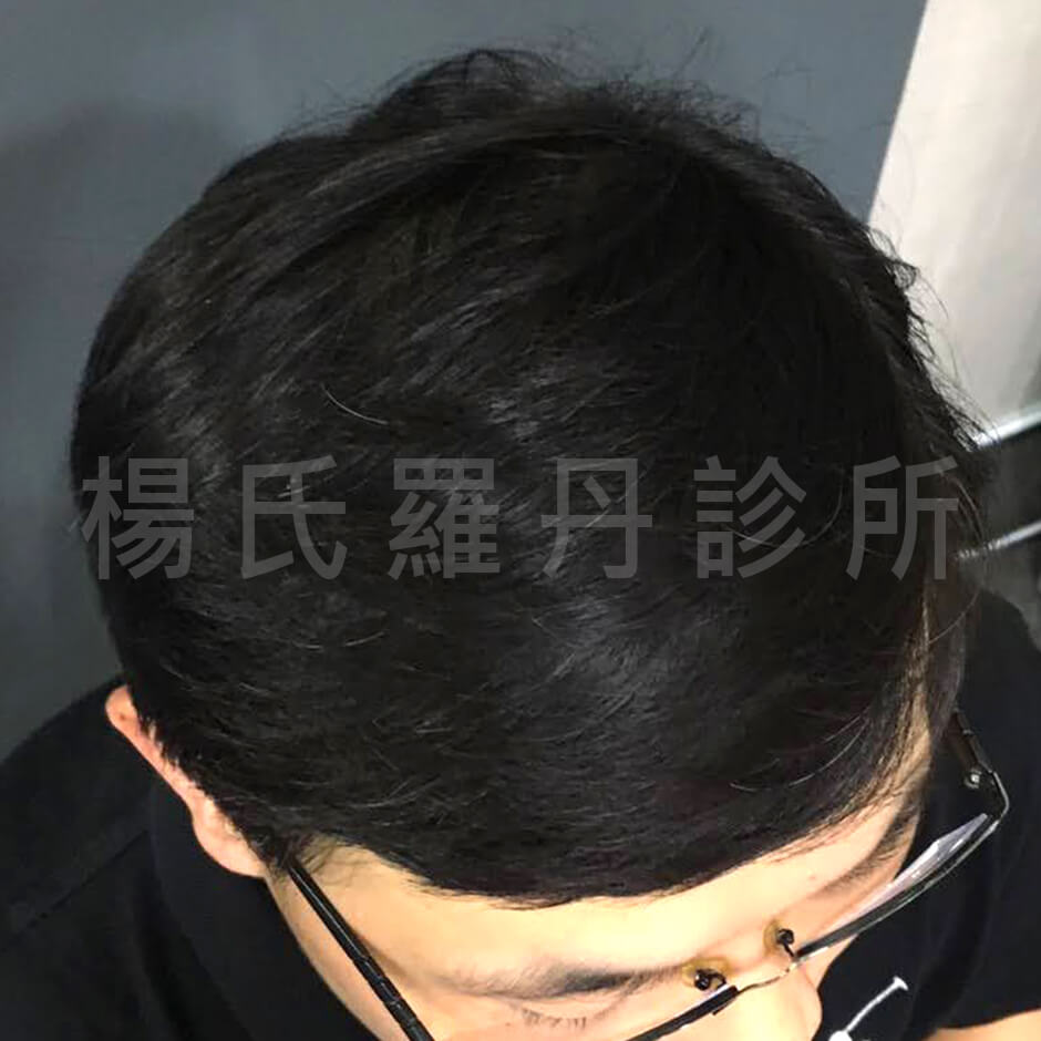 禿頭 植髮 掉髮