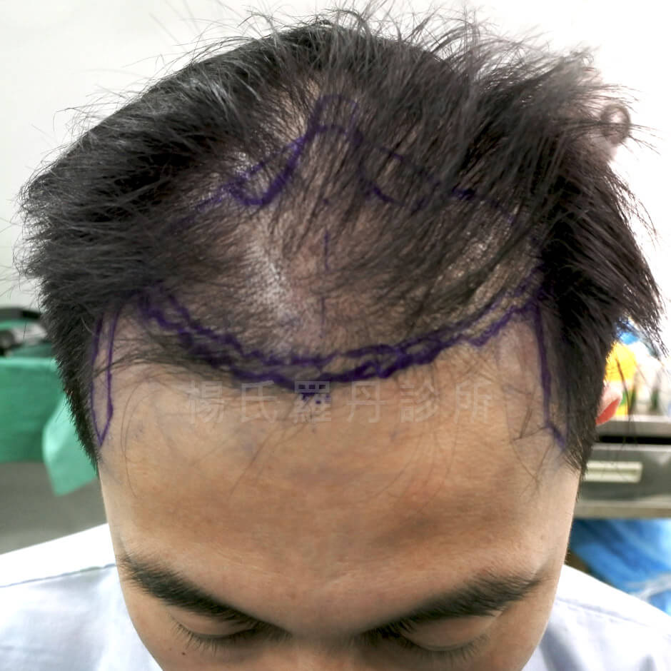 掉髮 植髮案例 植髮