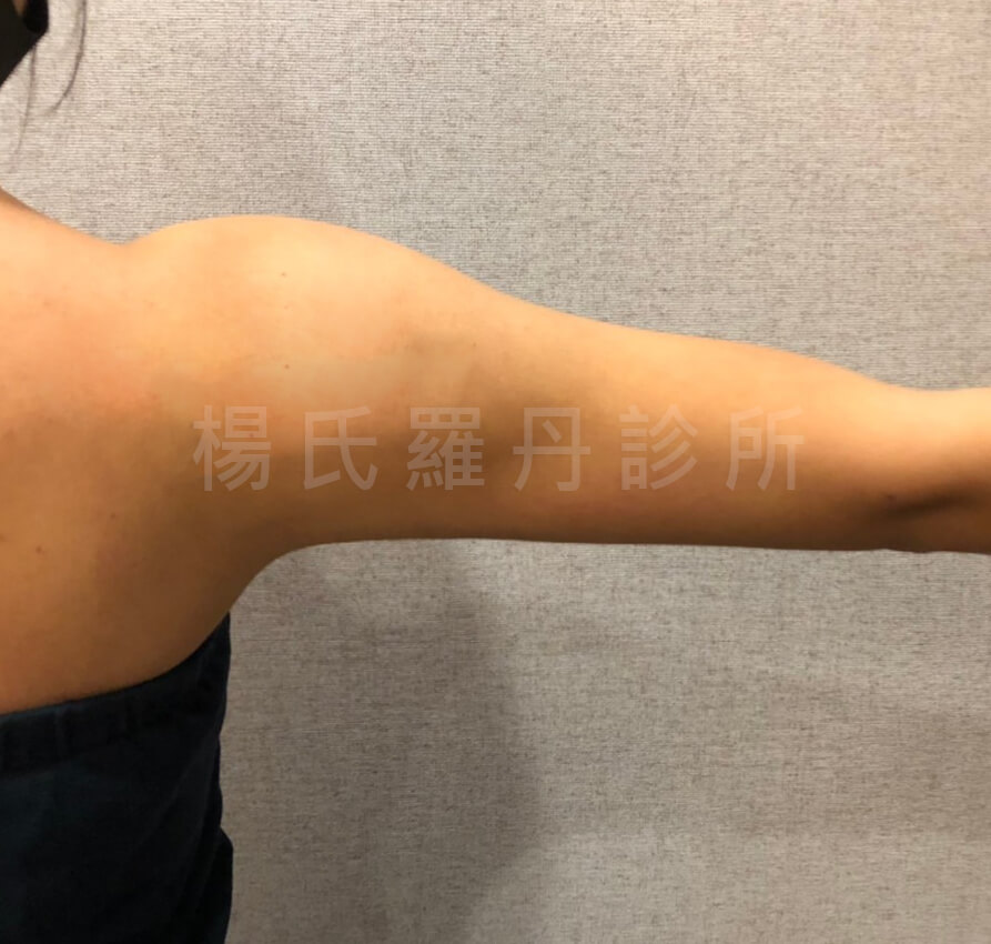 雷射減脂  瘦手臂 手臂