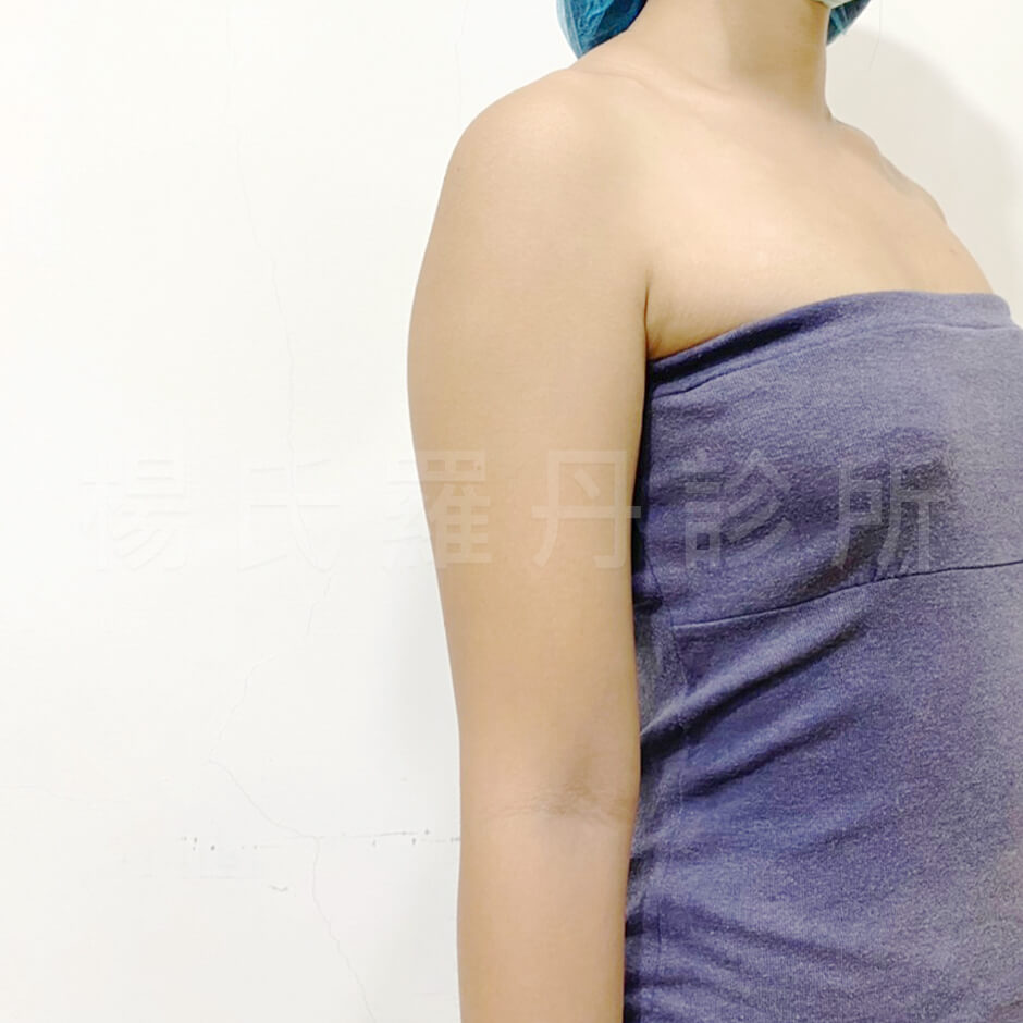 瘦手臂 雷射減脂