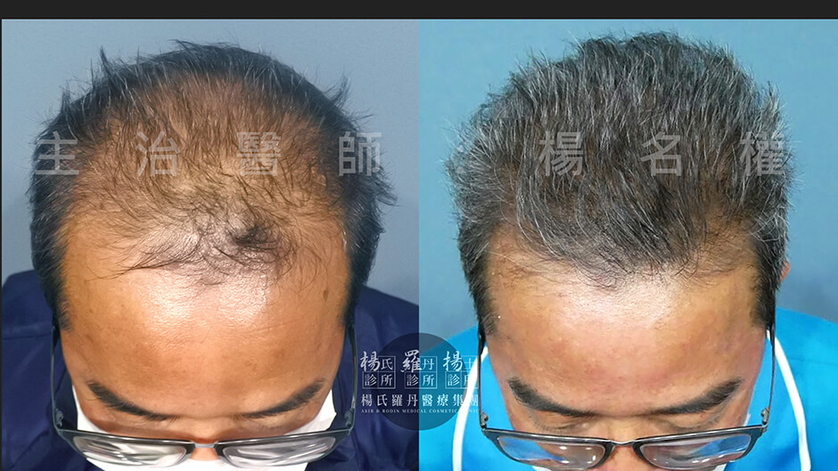 禿頭  掉髮 生髮