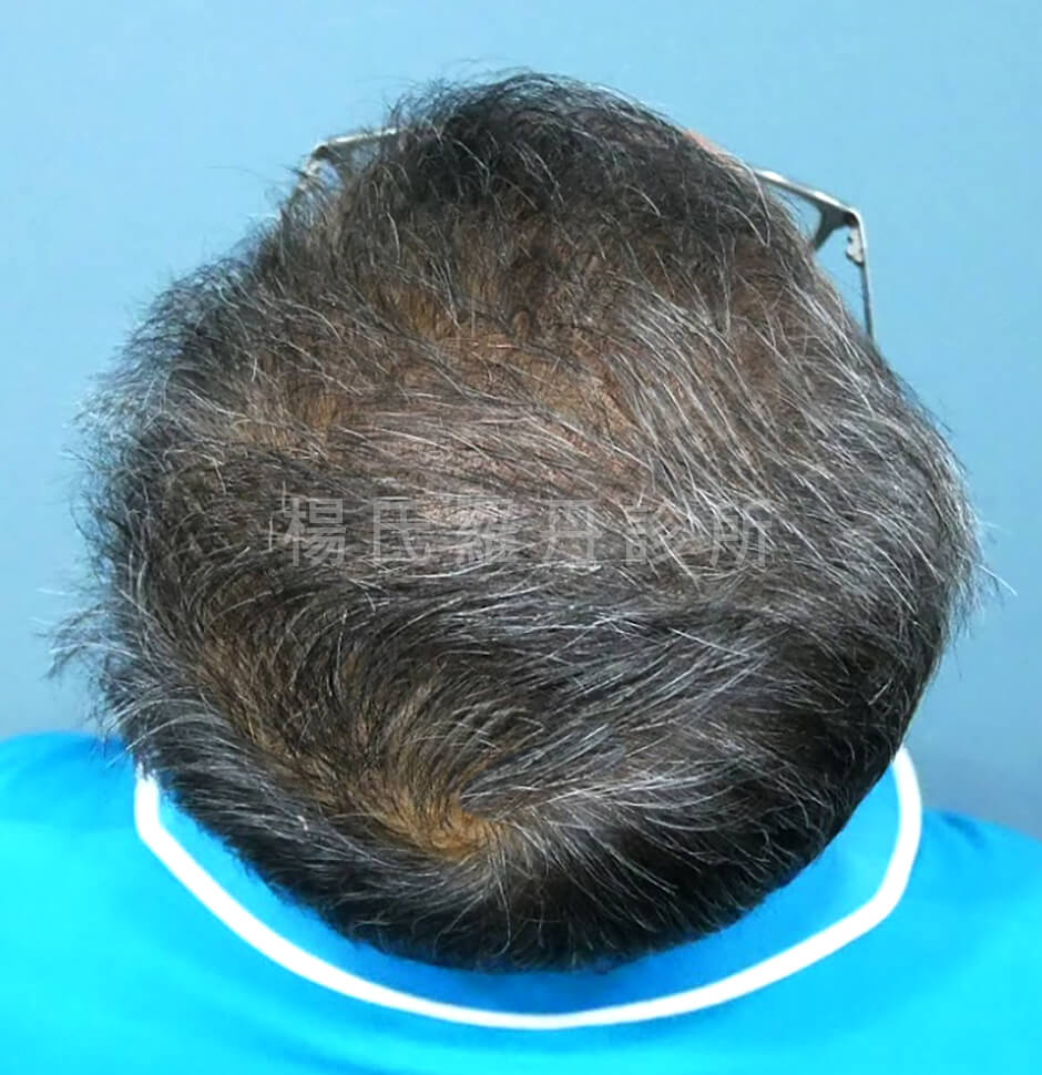 生髮療程 生髮613 掉髮 生髮