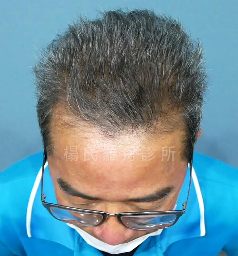 掉髮 禿頭 生髮 生髮613