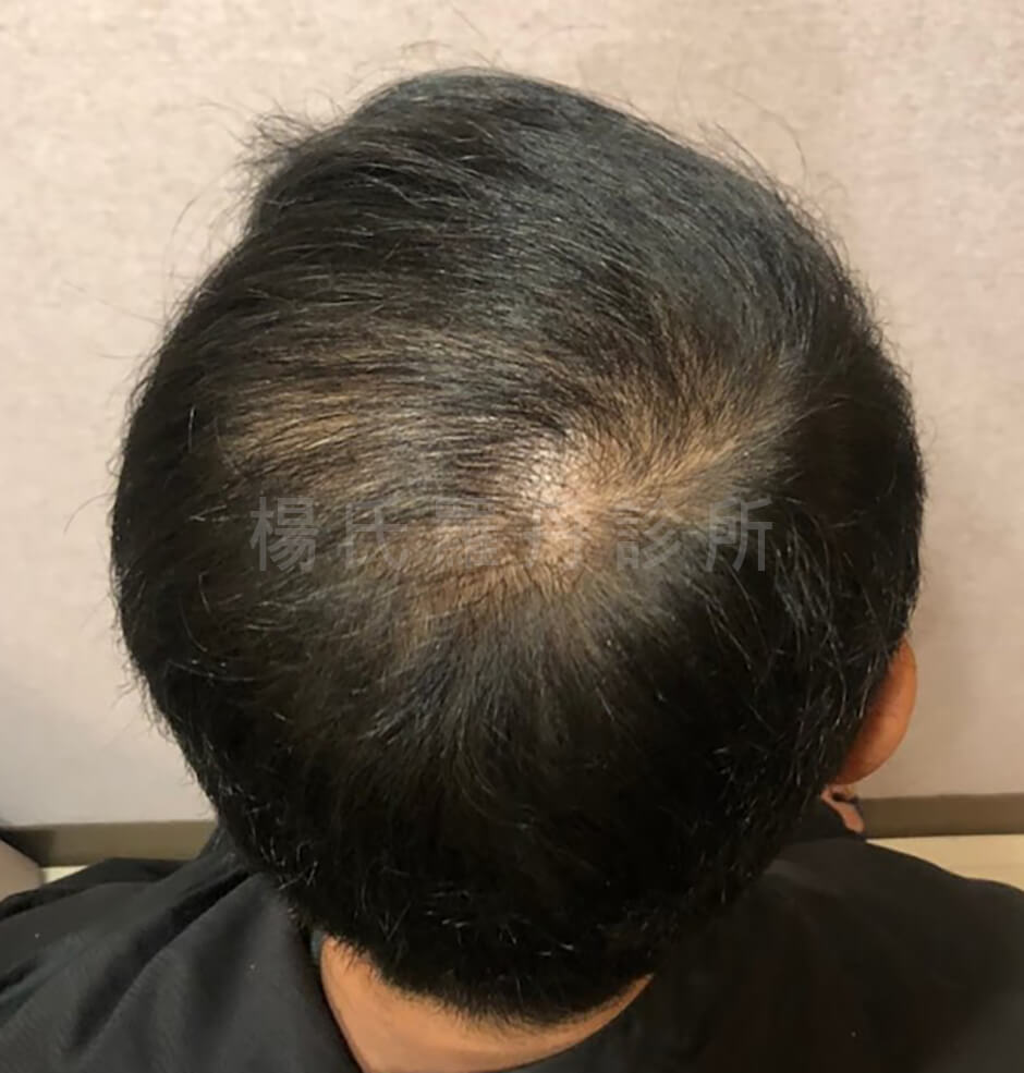禿頭治療 禿頭 植髮
