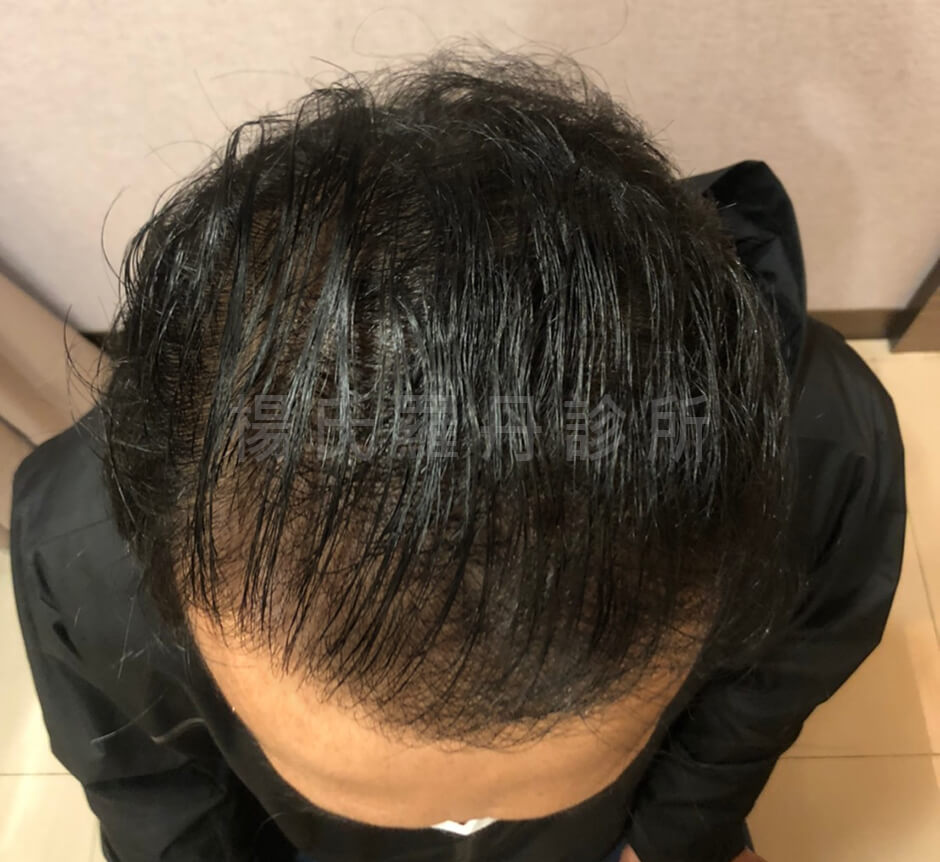 植髮 掉髮 植髮手術