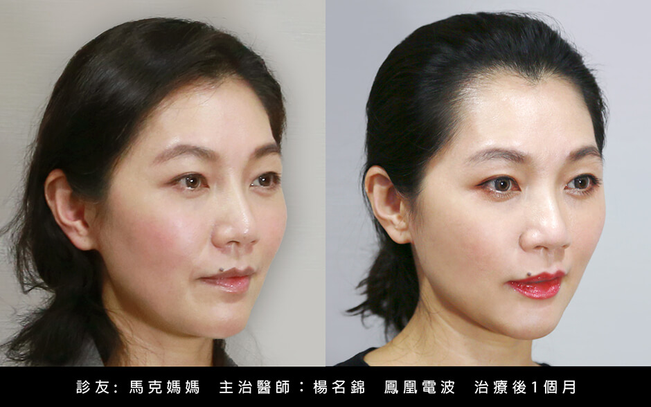 鳳凰電波 緊膚  馬克媽媽