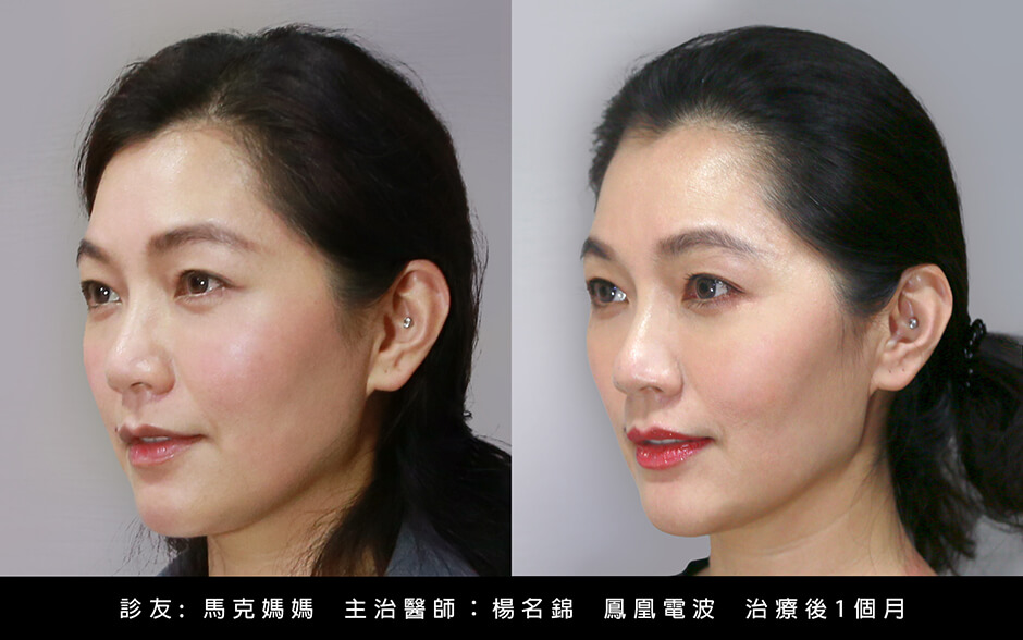 醫學美容 馬克媽媽  緊膚 鳳凰電波