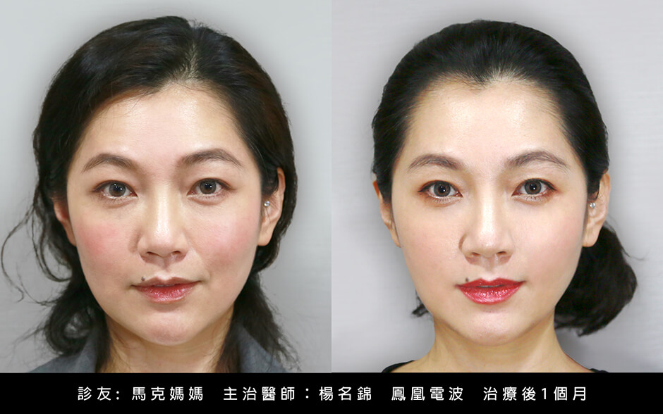 拉提 醫學美容 馬克媽媽 鳳凰電波