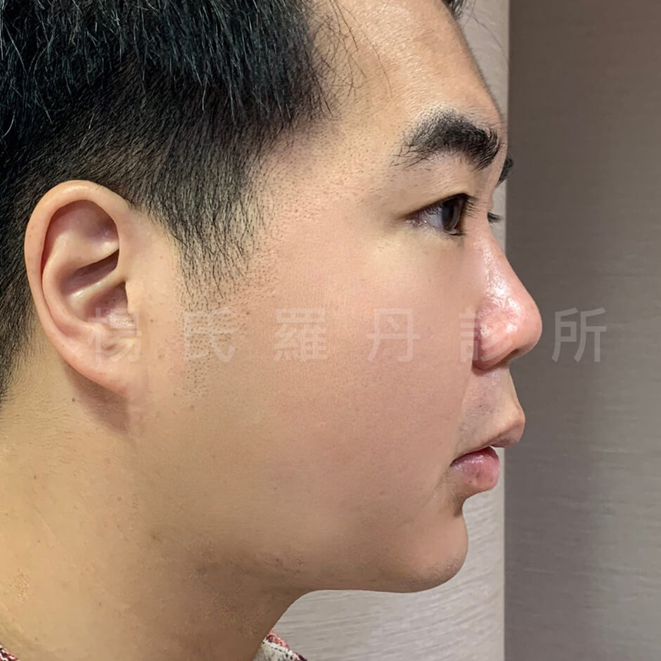 下巴 瘦下巴 小羊菌 雷射減脂