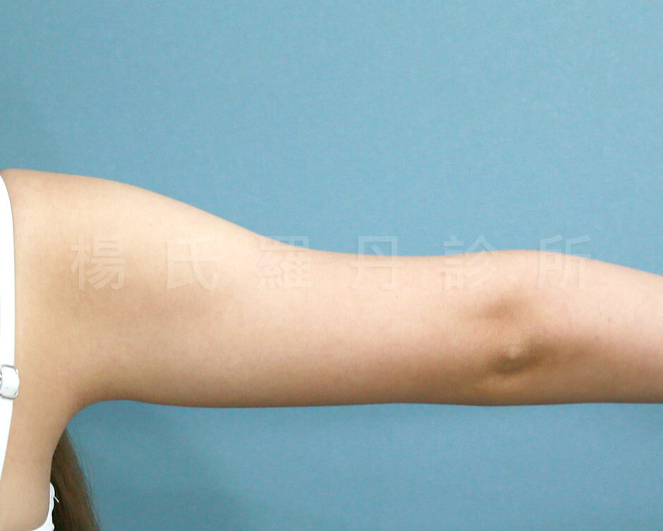 贅肉 雷射減脂 手臂