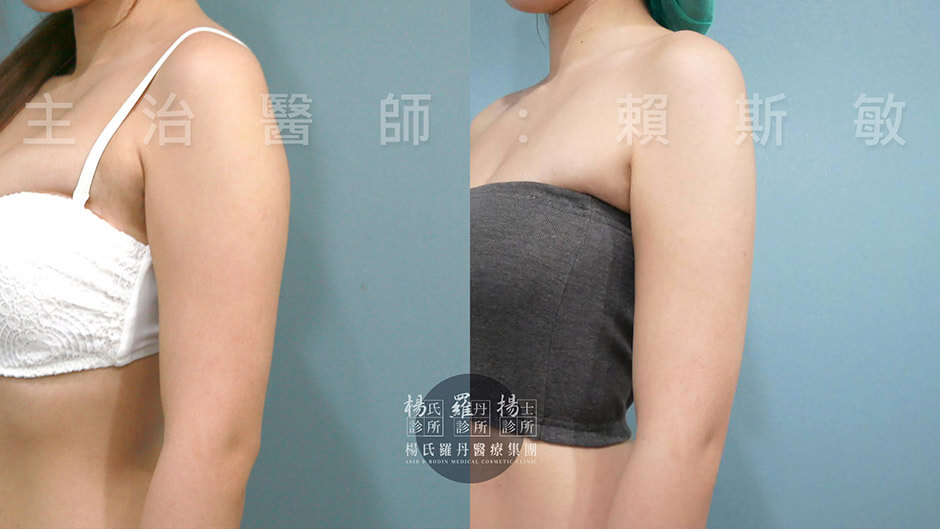 減脂手術 雕塑 雷射減脂