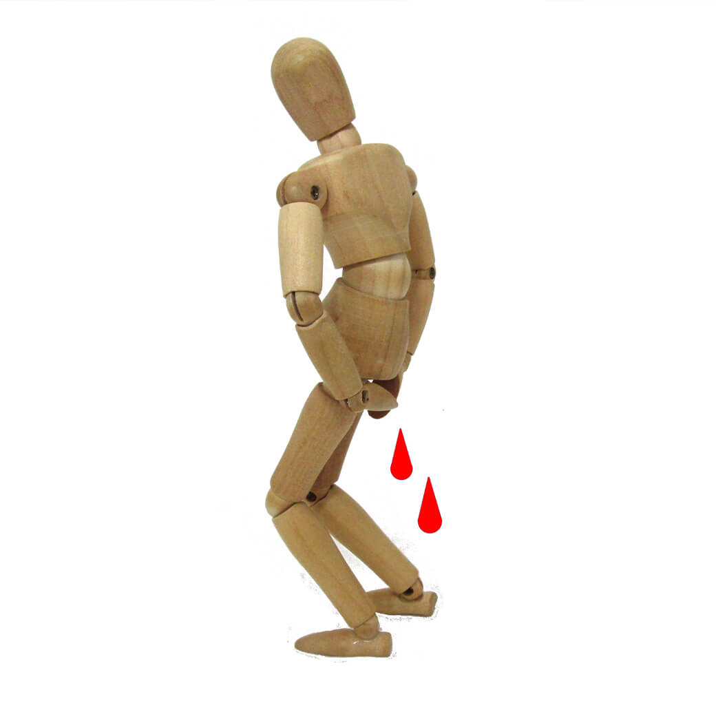 痔瘡 冷凝刀治療 冷凝刀 解決痔瘡