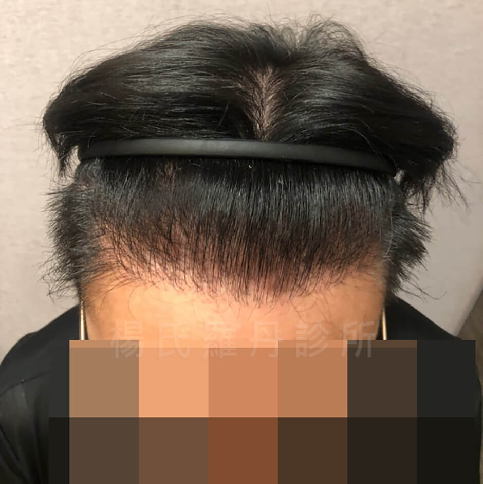 植髮成果 植髮 禿頭