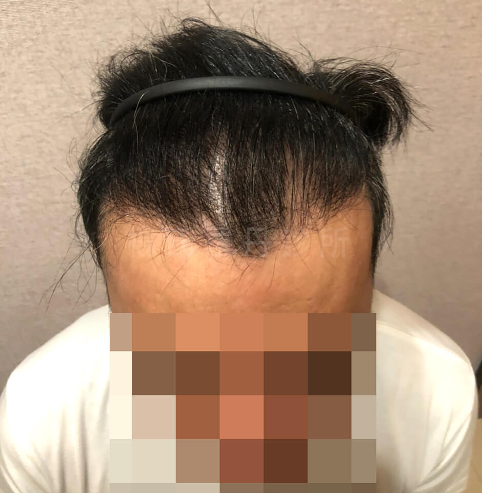 植髮 禿頭 掉髮