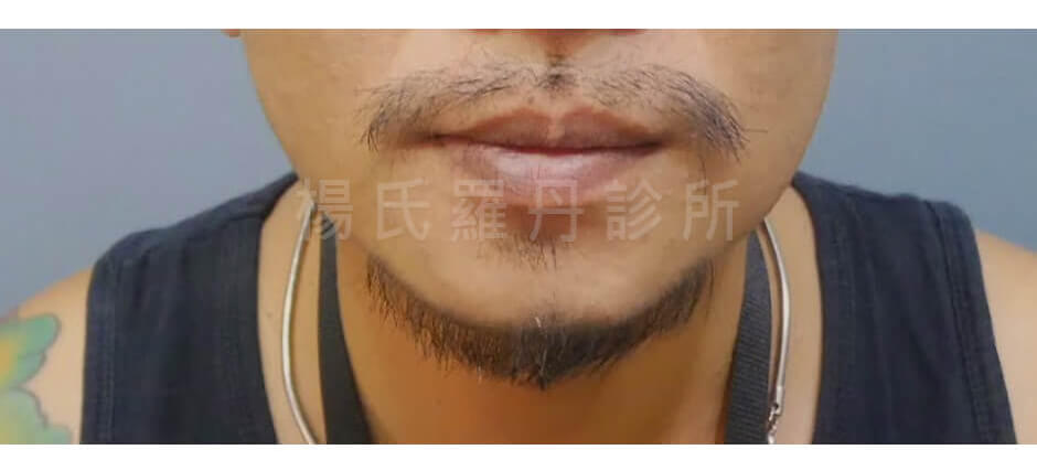 楊名權 植鬍 植鬍案例