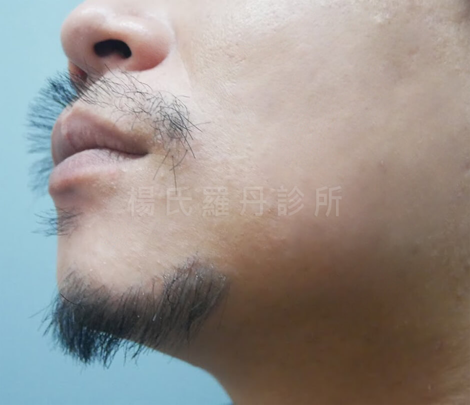 植髮 毛髮移植 植鬍