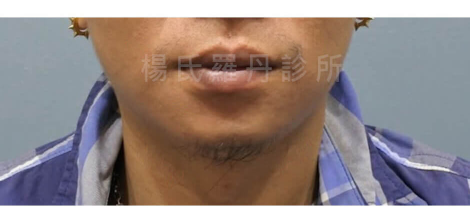 毛髮移植 植鬍案例 植鬍