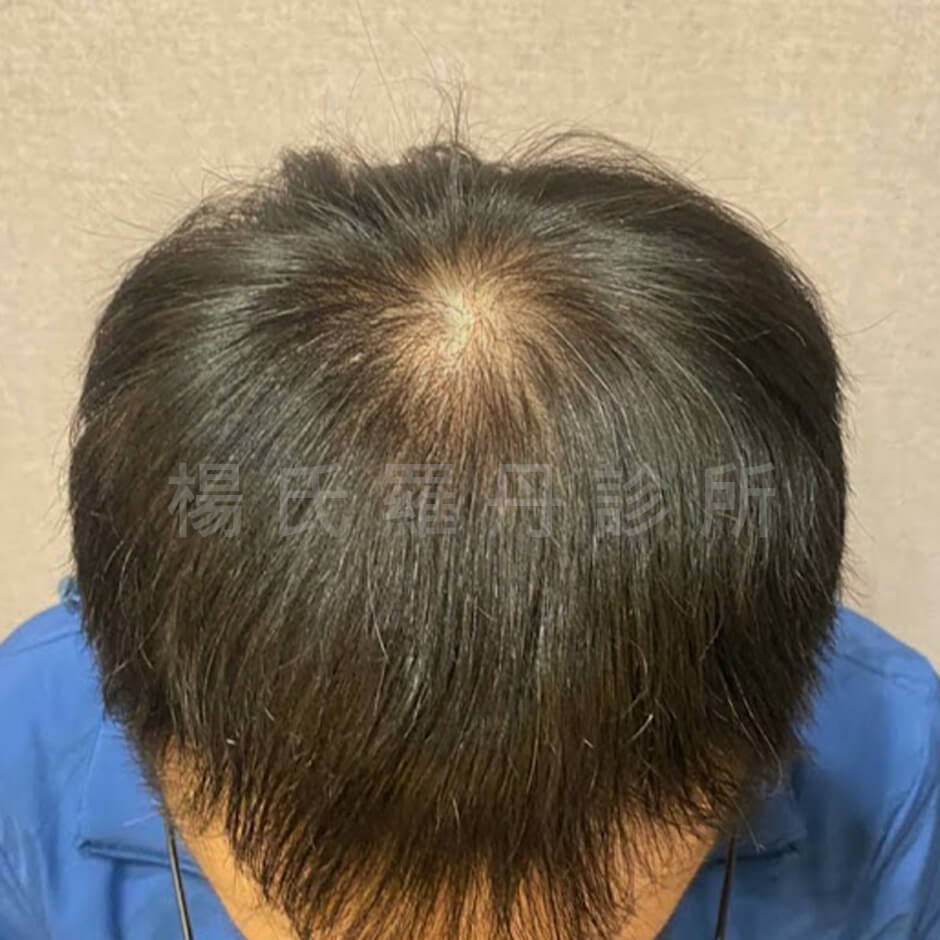 植髮 雄性禿 植髮效果