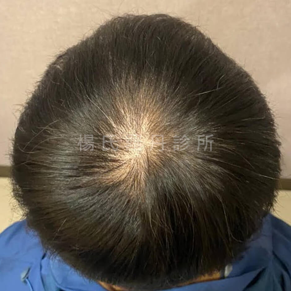禿頭 禿頭跡象 植髮